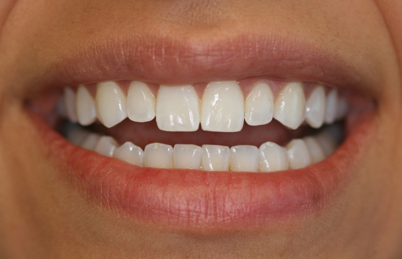 Cosmetic Dentistry and TMJ Undersized Lateral Incisors Can Corrected